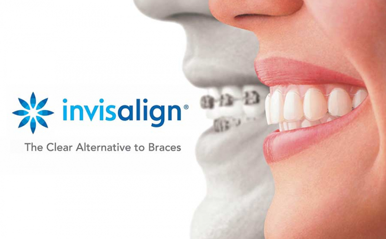 storitev invisalign