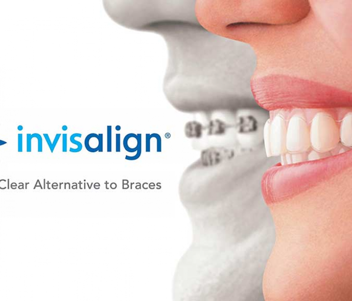 storitev invisalign